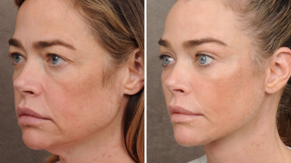 Denise Richards Shares Facelift Results With Before-and-After Photos